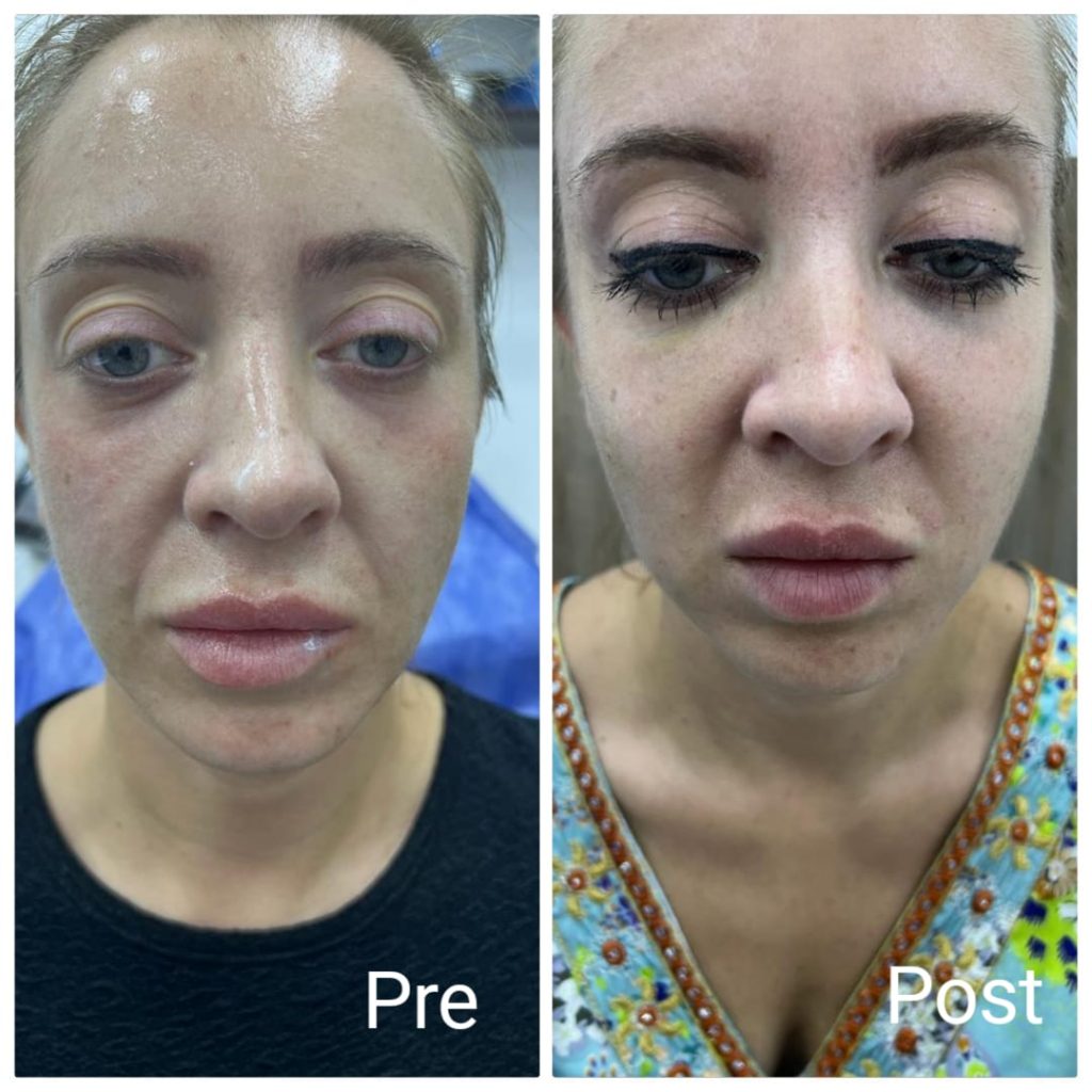 Plasma filler for cheeks at Nadara Med spa